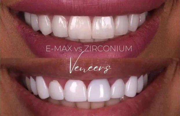 E-Max vs Zirconium Veneers: Which is The Best Option?