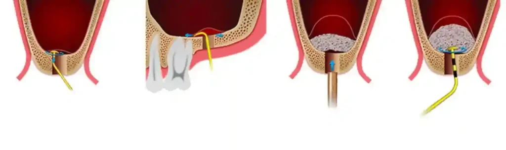 open-vs-closed-sinus-lifting