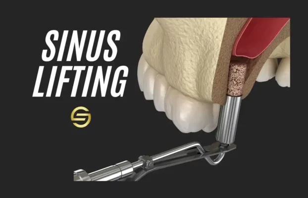 Sinus Lift Surgery: Boost Implant Success and Oral Health