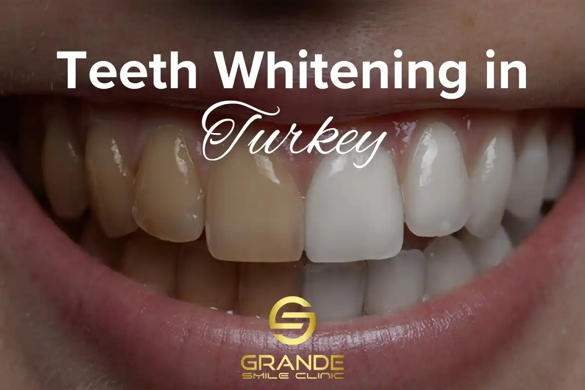Teeth Whitening in Turkey: Cost, Process, and Benefits