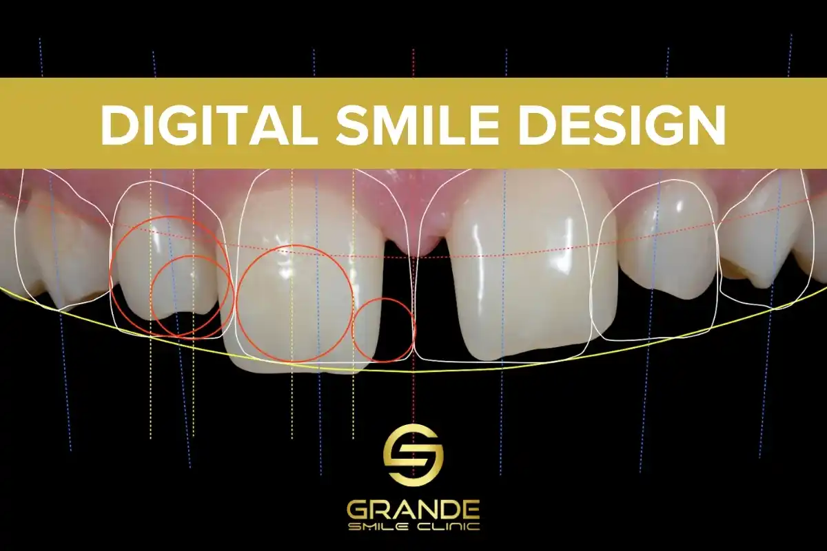 Digital Smile Design: Revolutionizing Aesthetic Dentistry