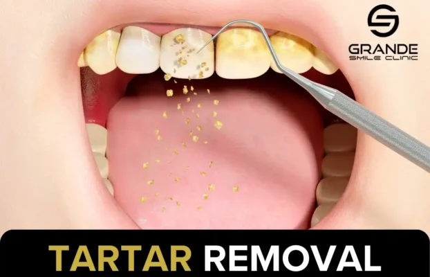 Tartar Removal: Costs, Risks, and Aftercare Explained