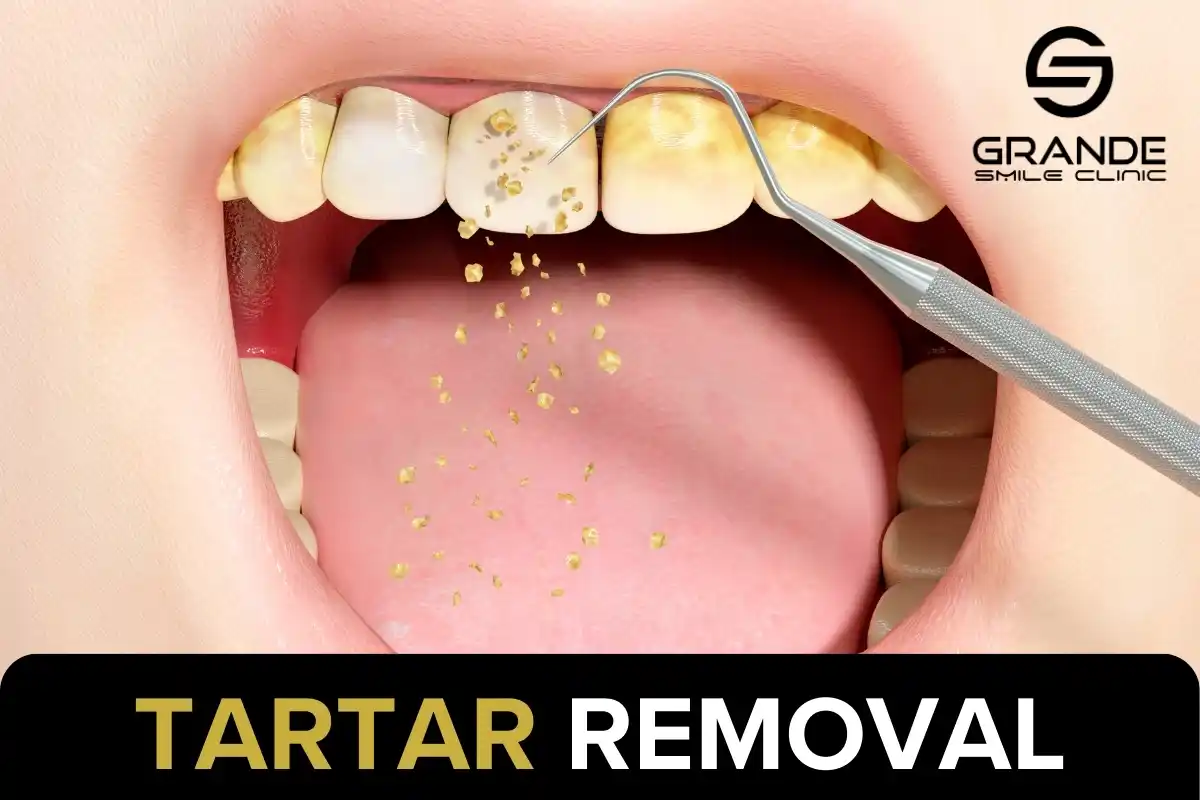 Tartar Removal: Costs, Risks, and Aftercare Explained