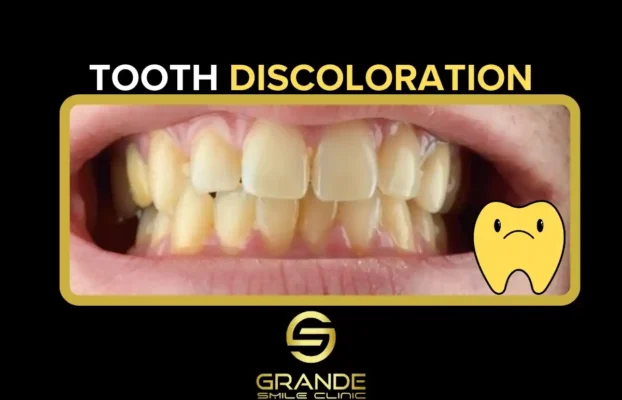 Causes of Tooth Discoloration and Treatment Options