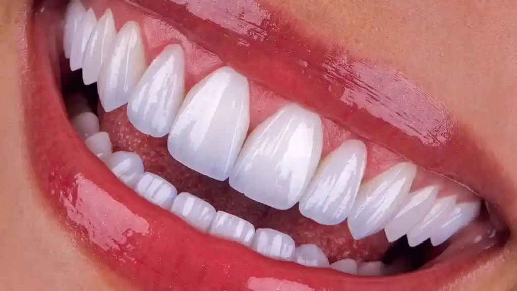 e-max teeth