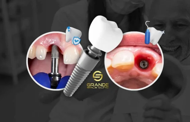 Post-Implant Care: Essential Guidelines for a Smooth Recovery