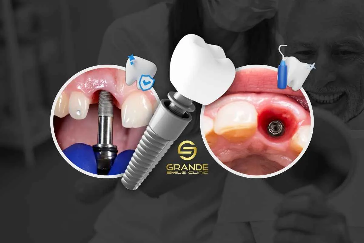 Post-Implant Care: Essential Guidelines for a Smooth Recovery