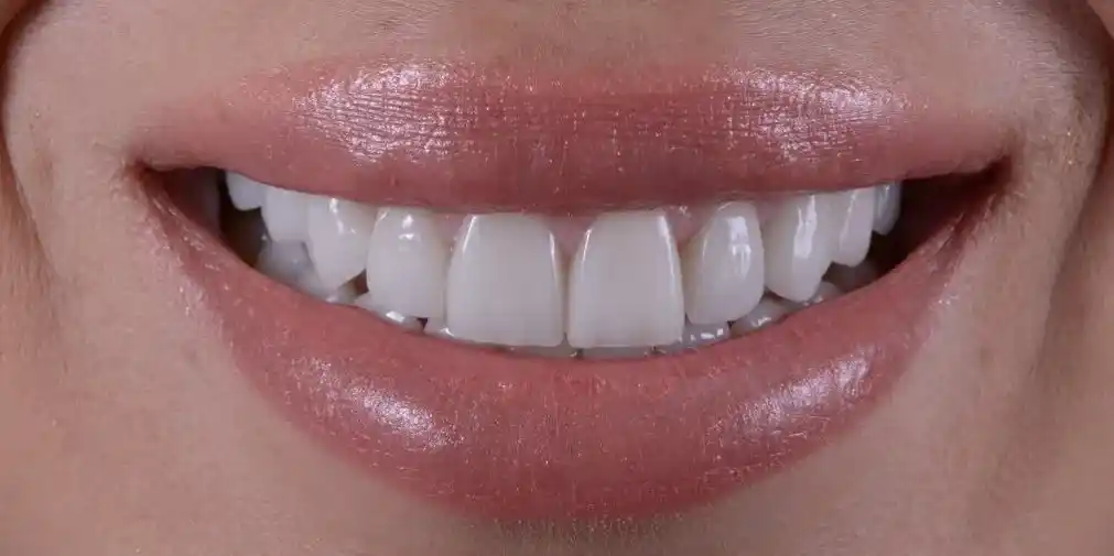 laminate teeth smile