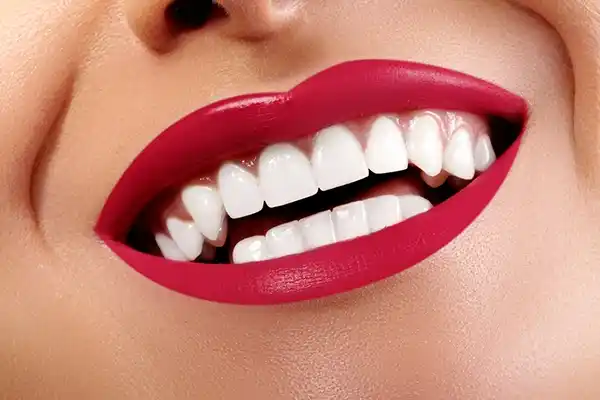 hollywood smile