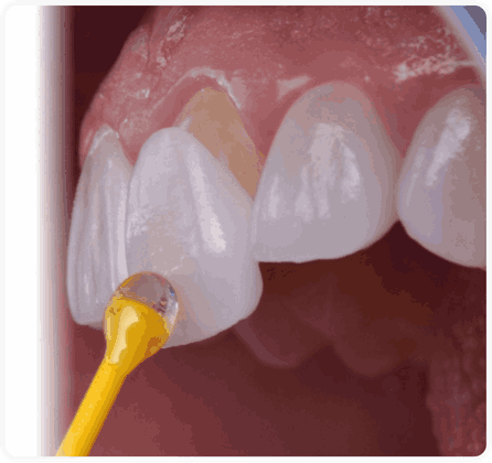 5) Bonding (Adhesive Cementation)