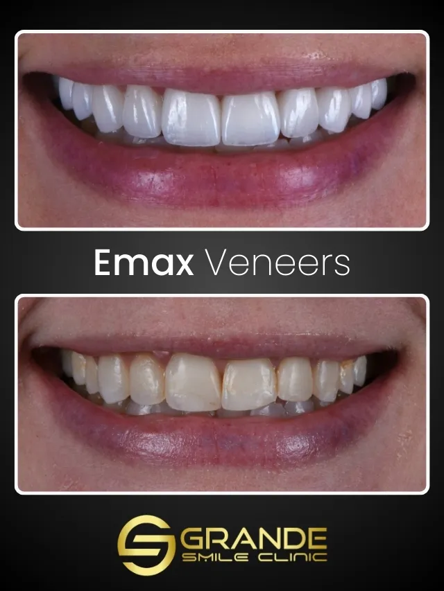 Emax Emax Laminate Veneers - Grande Smile Clinic