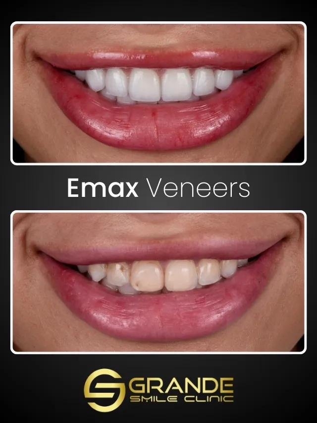 Emax Emax Laminate Veneers - Grande Smile Clinic