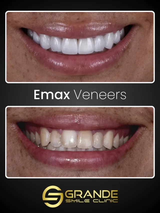 Emax Emax Laminate Veneers - Grande Smile Clinic