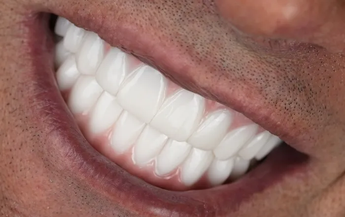 Teeth whitening and a brighter-looking smile