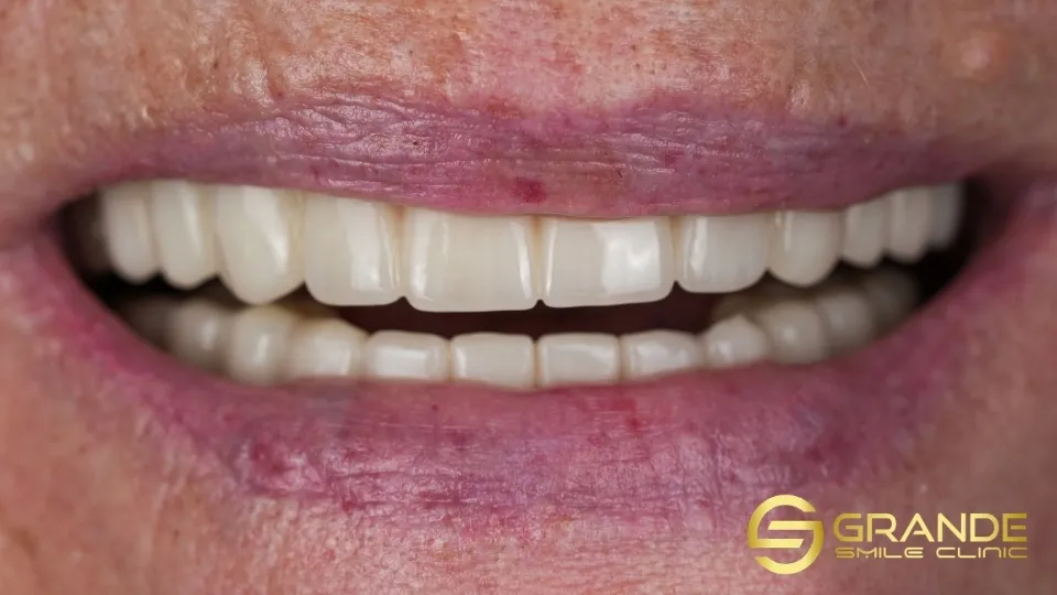 natural shade for dental crowns