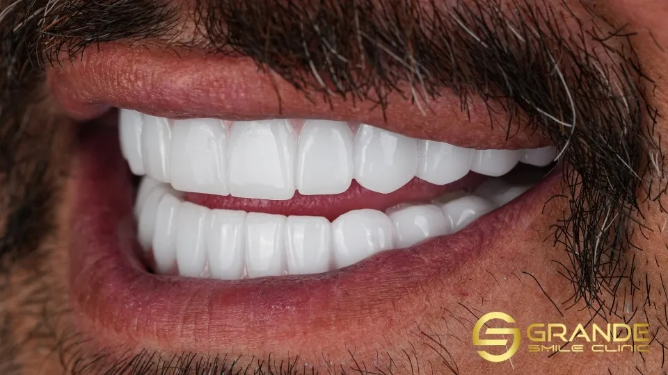 zirconium crown shade selection white shade example